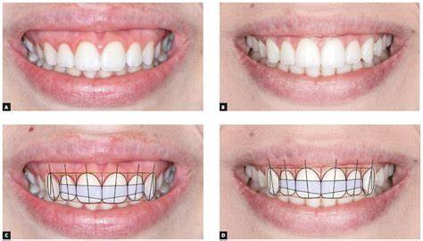 Gummy smile botox | What is gummy smile botox | Complete guide